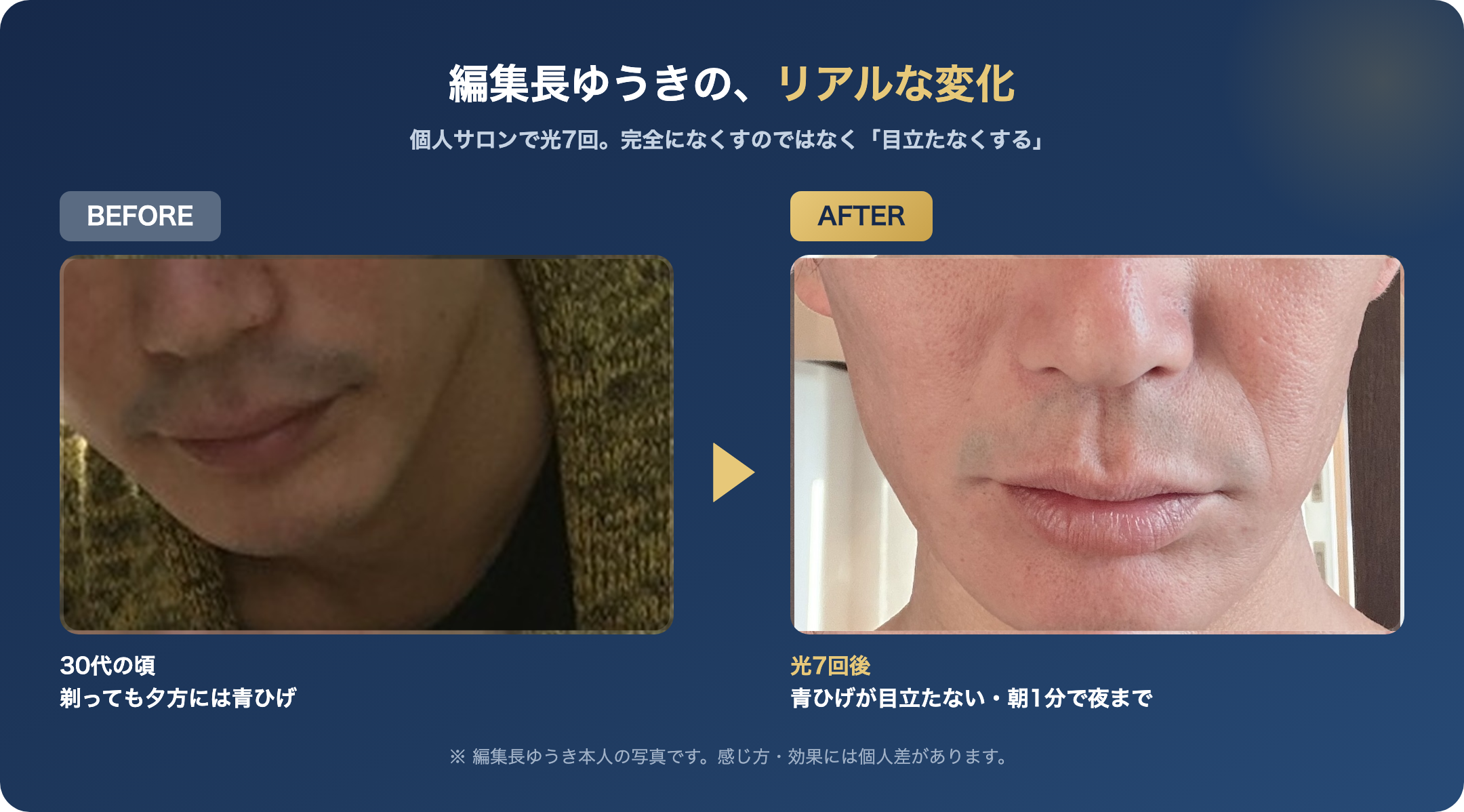編集長ゆうきのヒゲ脱毛の経過記録（光7回・個人の体験で個人差があります）